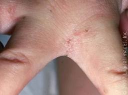 Steroid cream for eczema on hands